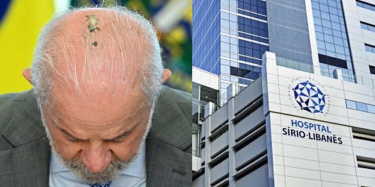 Lula passa por radioterapia no couro cabeludo após intervenção contra câncer de pele