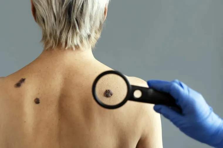 Câncer de pele: junho é mês de alerta para o melanoma